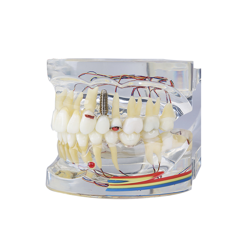 UM-4019-2 Pathologiemodel met zenuw
   