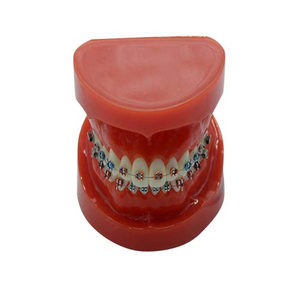 UM-B16 studiemodel met vaste beugels op tanden (normaal)