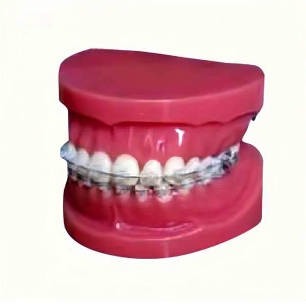UM-B17 studiemodel met vaste beugels op tanden (normaal)