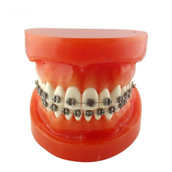 UM-B9 orthodontisch model (metalen beugels)