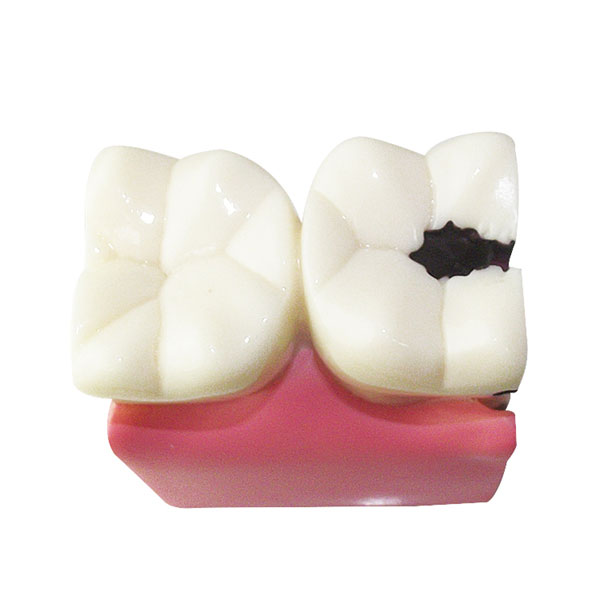 UM-L10-01 Caries Comparation