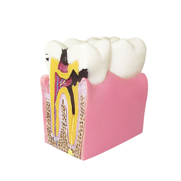 UM-L10-01 Caries Comparation