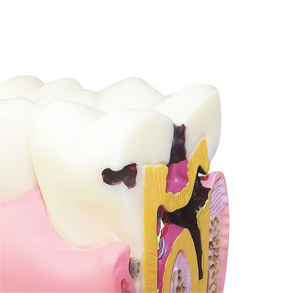 UM-L10-01 Caries Comparation