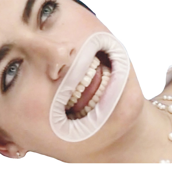 Dental Mouth Gag