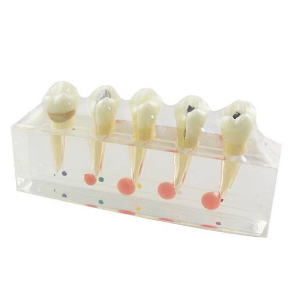 UM-L3A klinisch model van tand-en tandpulpziekte