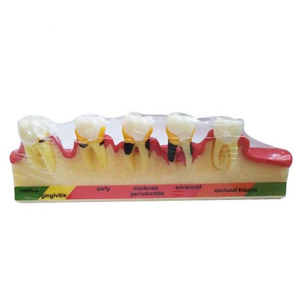 Um-e9 Periodontal Diseases Classification Model